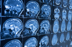 Common Types of Brain Injuries